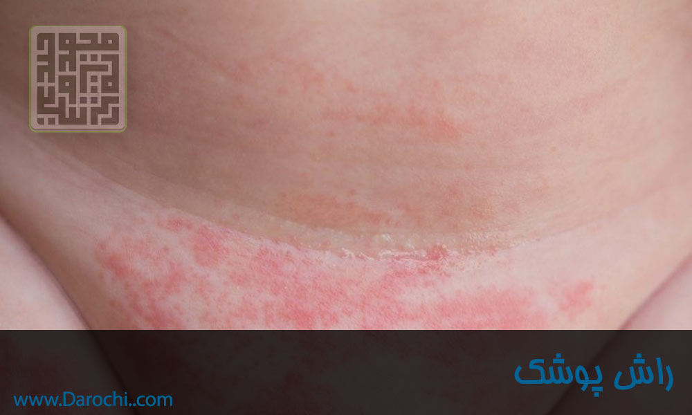 راش پوشک در نوزادان و کودکان (6)-min