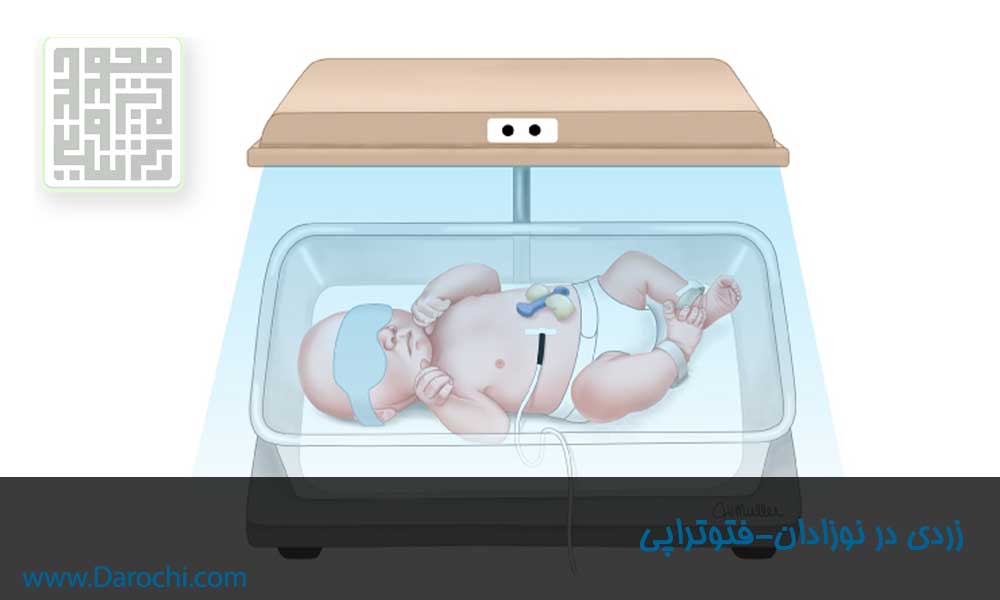 زردی در نوزادان فتوتراپی-داروچی (3)