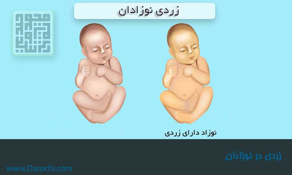 زردی در نوزادان-داروچی (4)