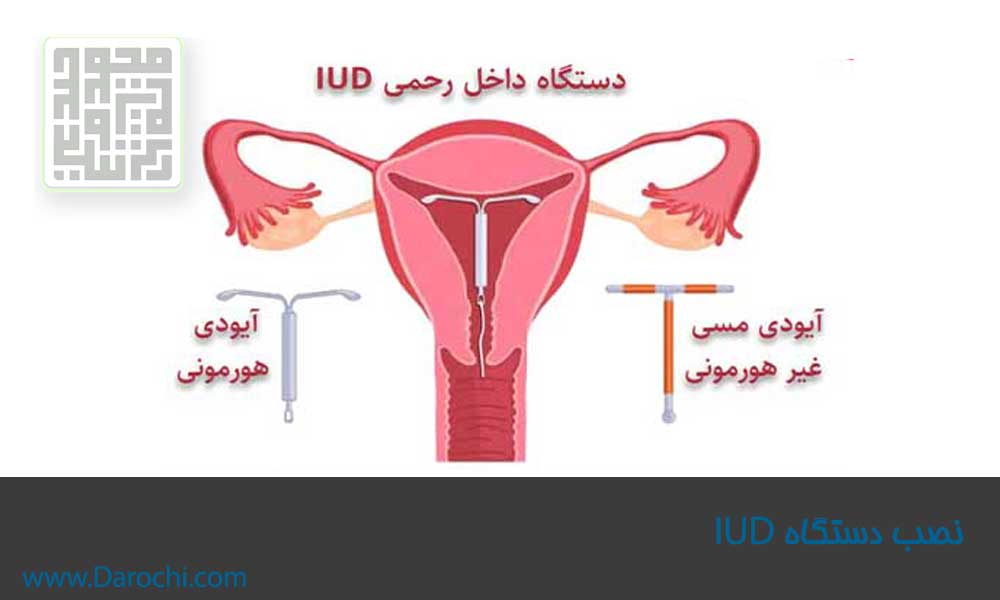 نصب دستگاه آی یو دی - داروچی
