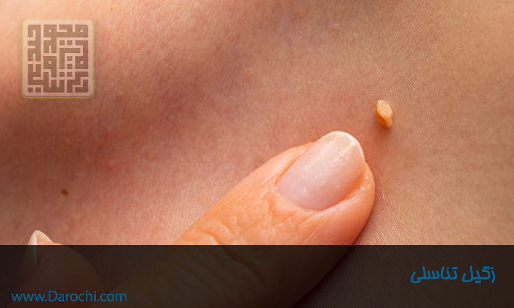 تشخیص زگیل تناسلی-داروخانه داروچی