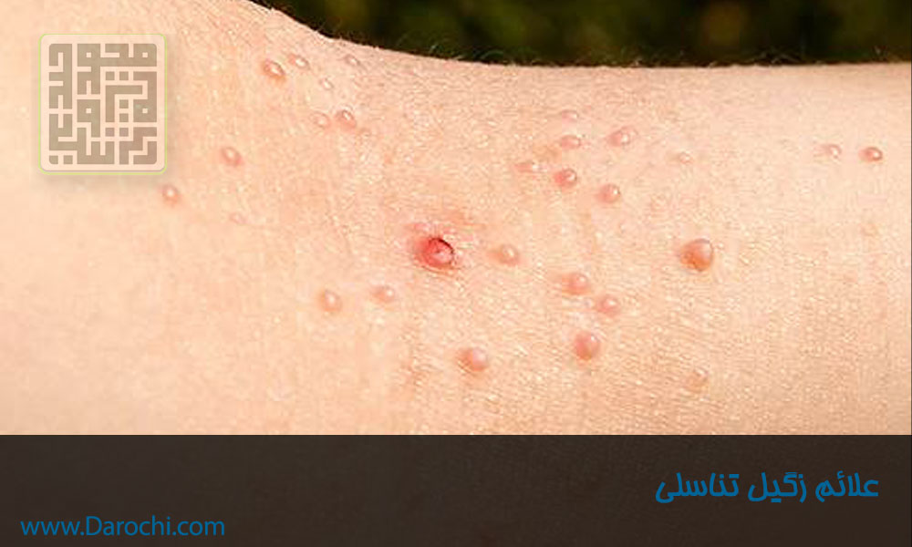 --داروخانه داروچی -علائم زگیل تناسلی