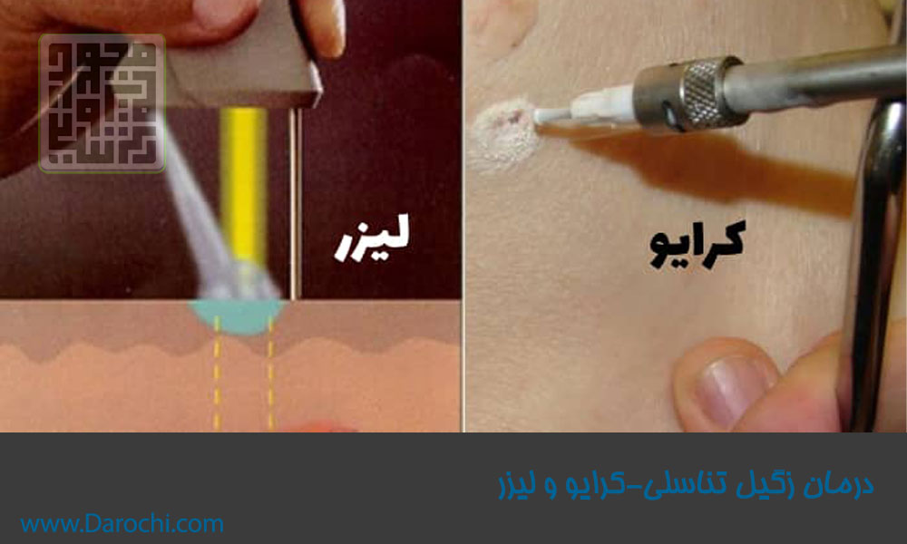 درمان زگیل تناسلی لیزر-کرایو-داروخانه داروچی