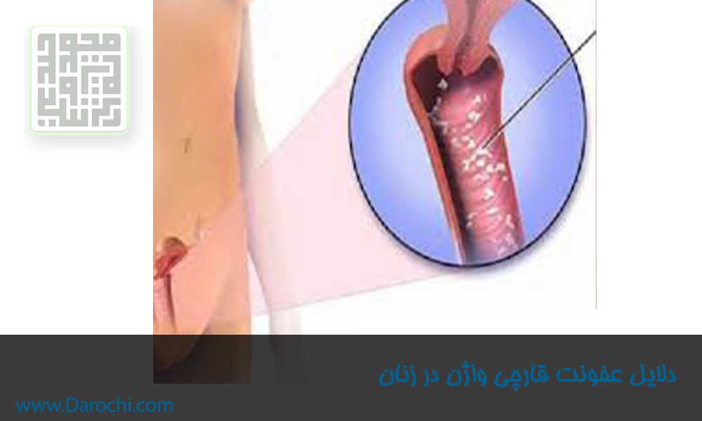 دلایل عفونت قارچی واژن در زنان- داروچی