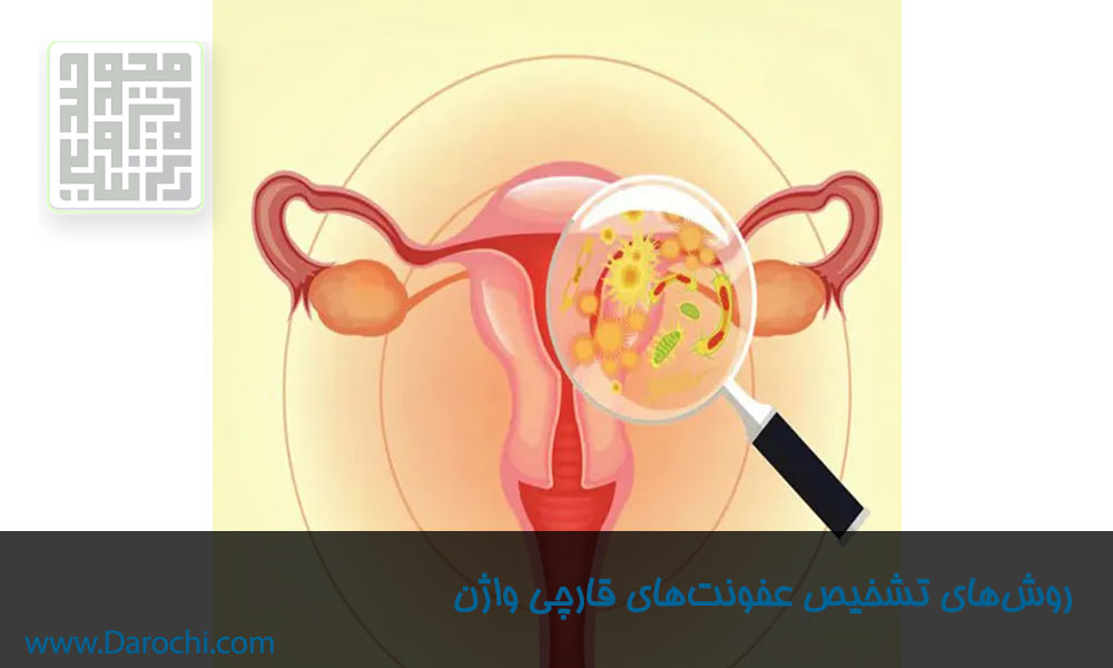 روش‌های-تشخیص-عفونت‌های-قارچی-واژن