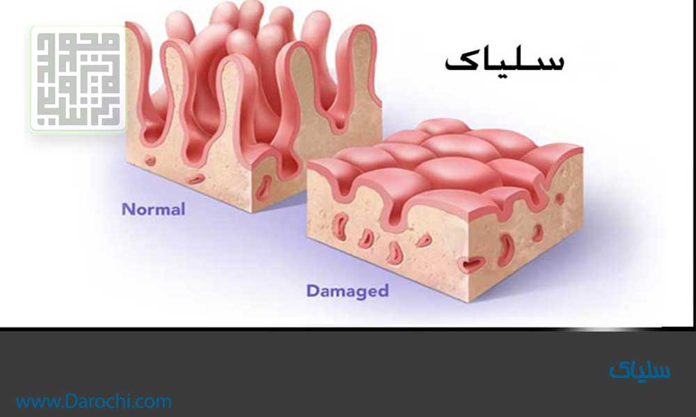 سلیاک در کودکان-داروچی