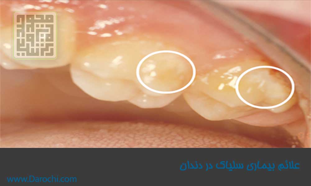 علائم-بیماری-سلیاک-روی-دندان