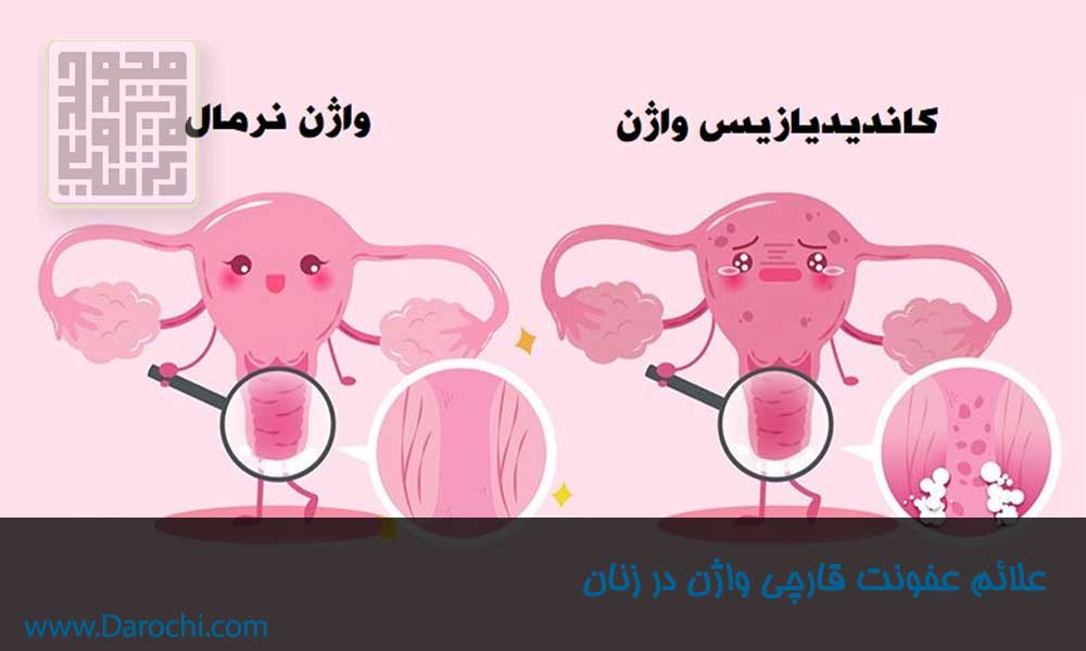 علائم عفونت قارچی واژن در زنان- داروچی