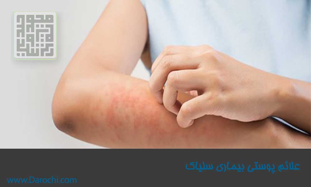 علائم پوستی سلیاک 2-داروچی