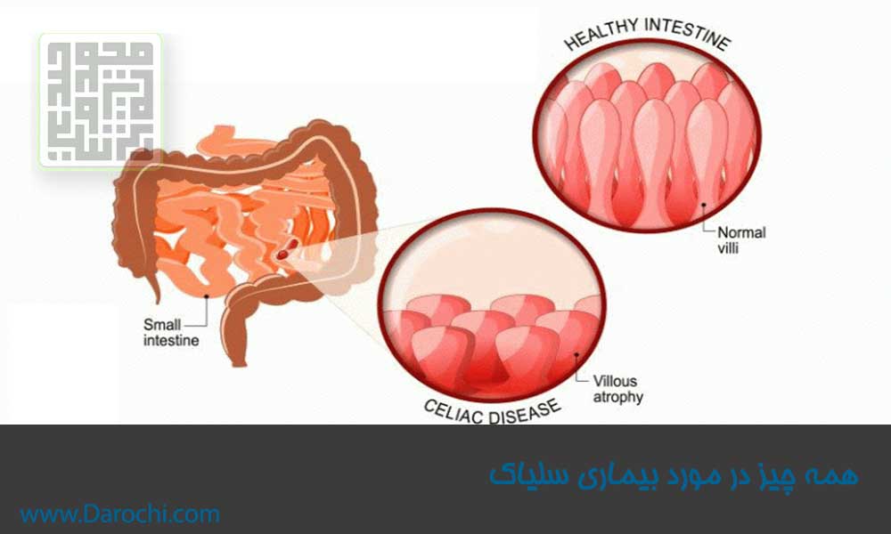 همه چیز در مورد بیماری سلیاک-داروچی