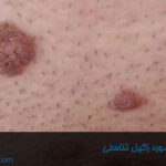 همه چیز در مورد زگیل تناسلی-داروخانه داروچی