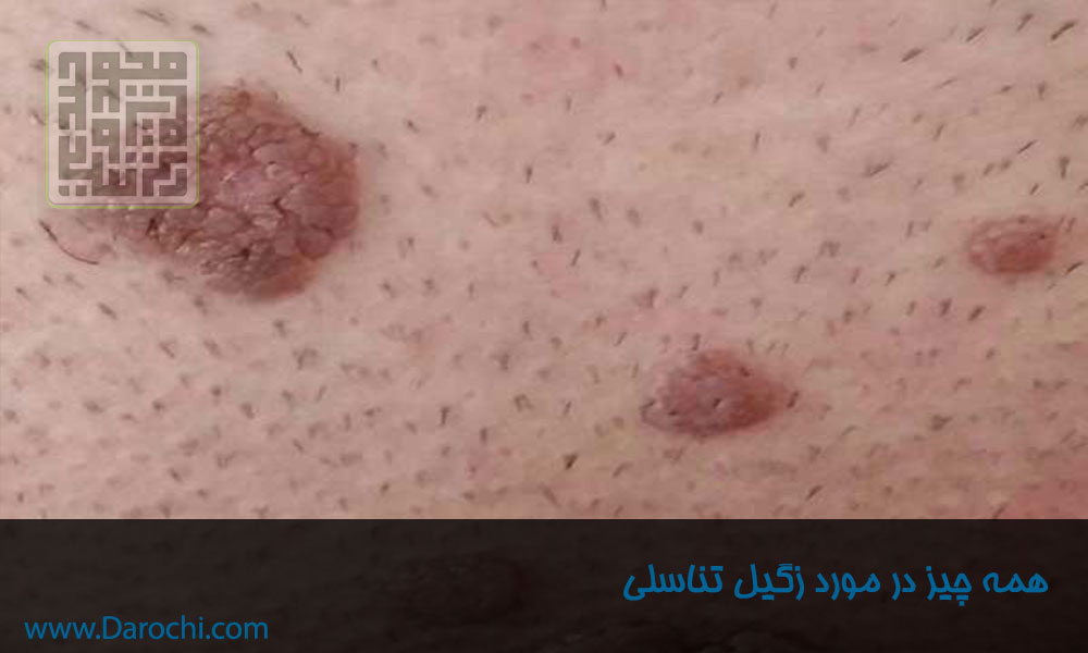 همه چیز در مورد زگیل تناسلی-داروخانه داروچی