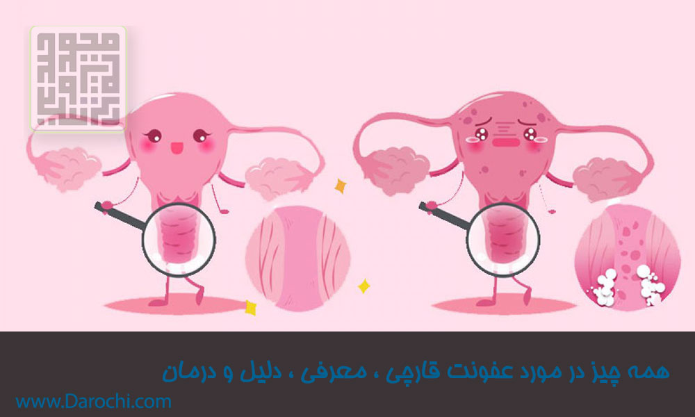 همه چیز در مورد عفونت قارچی ، معرفی ، دلیل و درمان(STIs)