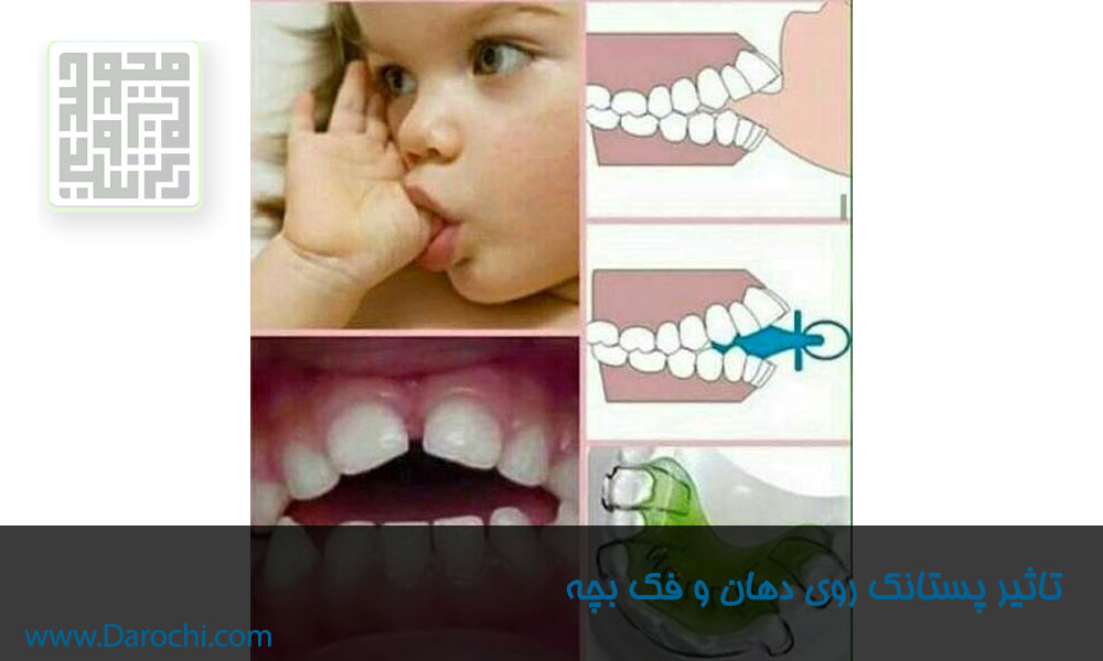 تاثیر-پستانک-روی-دندان-و-فک-کودک