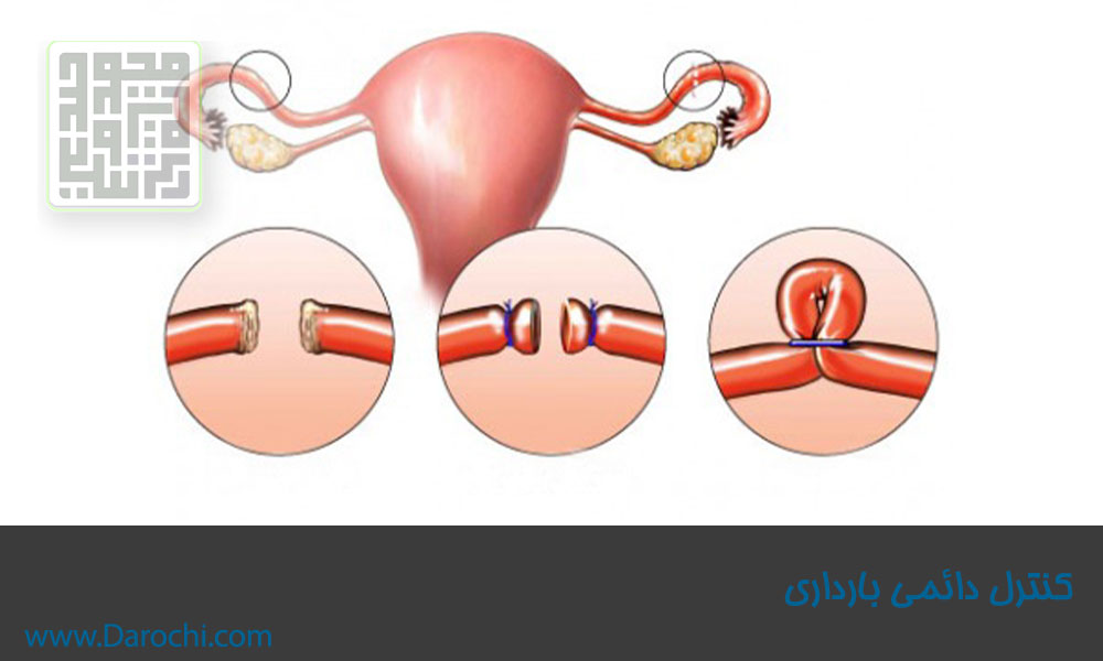 کنترل-دائمی-بارداری