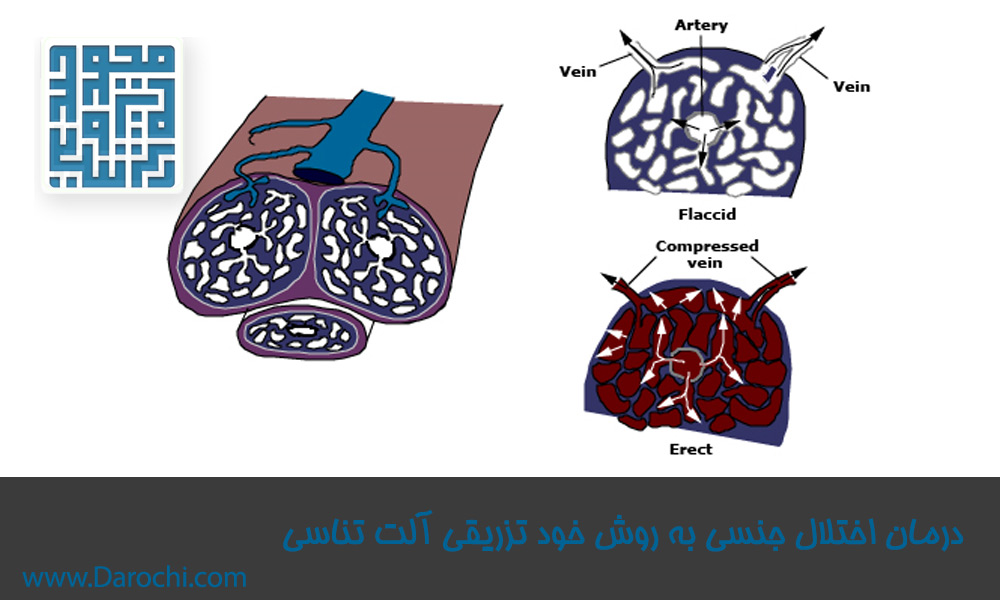 درمان-اختلال-جنسی-به-روش-خود-تزریقی-آلت-تناسی