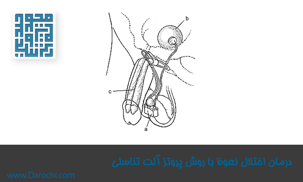 درمان-اختلال-نعوظ-با-روش-پروتز-آلت-تناسلی 