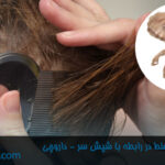 8 تا از باورهای غلط در رابطه با شپش سر-داروخانه داروچی