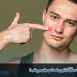 تاثیر کراتین روی پوست، آیا کراتین باعث جوش می‌شود؟