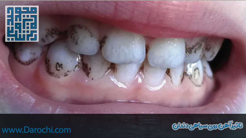 تاثیر آهن روی سیاهی دندان