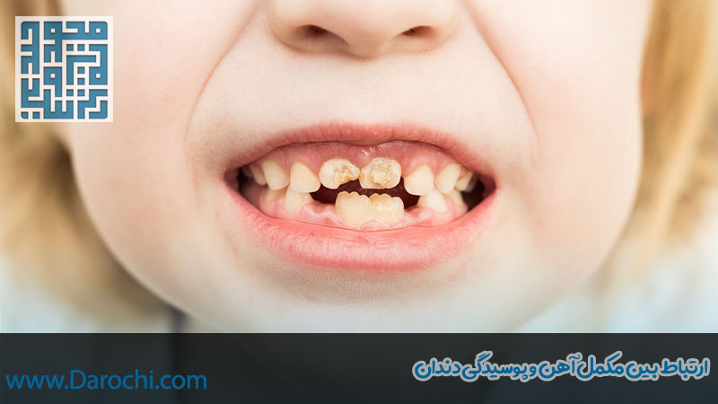 قطره آهن و پوسیدگی دندان